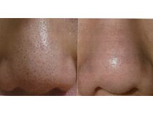 玉響(Tamayura)/毛穴の大掃除♪アクアピーリング