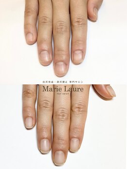 マリーロール 梅田店(Marie Laure)/自爪育成/深爪矯正/ネイルケア