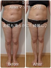 ヨサパーク アエル(YOSA PARK AELL)/5回施術後/よもぎ蒸し/下半身