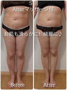 ヨサパーク アエル(YOSA PARK AELL)/5回施術後/よもぎ蒸し/下半身