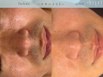 スキンラボアメリ(skin lab. ameri)/お悩み…毛穴