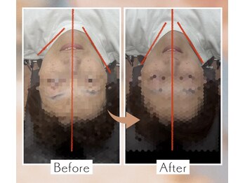 くすの木 治療院/顎の歪みとフェイスライン