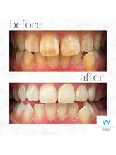 ホワイトニングショップ 広島店(WHITENING SHOP)/【ホワイトニング】Before After