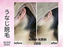 アルゴ 山口宇部店(ALGO)/その日に！うなじ脱毛+WAX