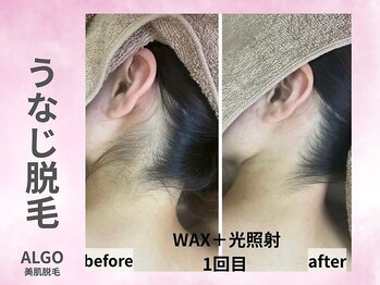 アルゴ 山口宇部店(ALGO)/その日に!うなじ脱毛+WAX