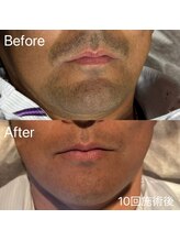 エピノン 山口岩国店(Epinon)/顔脱毛　ビフォーアフター