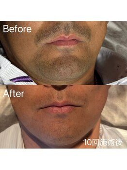 エピノン 山口岩国店(Epinon)/顔脱毛 ビフォーアフター