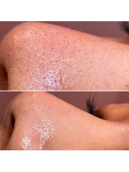 エステティックサロン S/毛穴ケアビフォーアフター