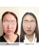 サロン レインボー(SALON RAINBOW)/小顔集中コース　Before/After