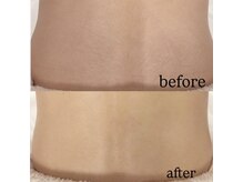 エムズワン 都ホテル店(M'S ONE)/背中シェービングbefore→after