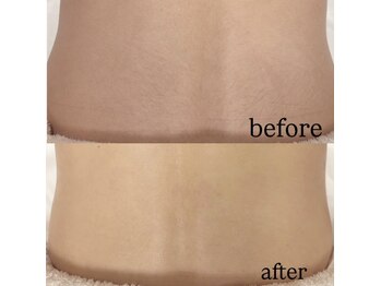 エムズワン 都ホテル店(M'S ONE)/背中シェービングbefore→after