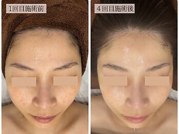 リノン(LINON)/ハーブピーリング 施術回数4回