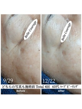 ベルクラージュ(Belle Courage)/60代　シワ・シミ・くすみ