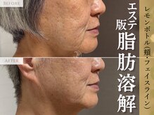 アポシェ(apoche)/エイジング/下垂脂肪/口横ぽにょ