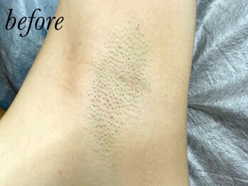 ゴールデンアイ 谷山店(Golden eye)/最新ダブル方式脱毛で結果が早い