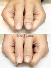 マリーロール 梅田店(Marie Laure)/自爪育成/深爪矯正/ネイルケア