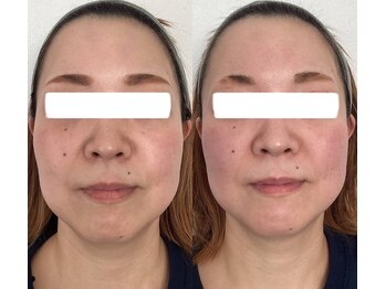 エムズサロン(m’sサロン)/初回1回でのビフォーアフター