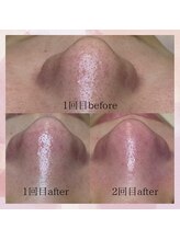 ビオルブ(VIOLVE)/つるつる毛穴で美人肌/毛穴ケア