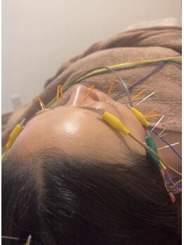 マル(malu)/美容鍼