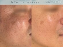 スキンラボアメリ(skin lab. ameri)/お悩み…毛穴シミ