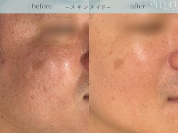 スキンラボアメリ(skin lab. ameri)/お悩み…毛穴シミ