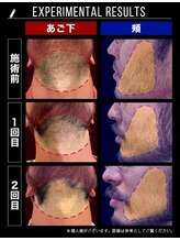 メンズ脱毛専門　RBLゆめタウン出雲店 【ヒゲ脱毛・全身脱毛・VIO】/メンズ脱毛/ヒゲ脱毛施術2回目