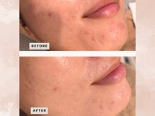 ハナ チュチュ(Hana chuchu)/デコボコ肌がなめらかに♪