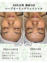 シーフェイス 横浜店(SEE FACE)/毛穴肌質改善ハーブピーリング