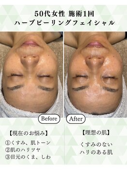 シーフェイス 横浜店(SEE FACE)/毛穴肌質改善ハーブピーリング
