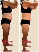 クリニカルエステ イーズ あべのキューズタウン店/【レモンボトルポッコリお腹解消