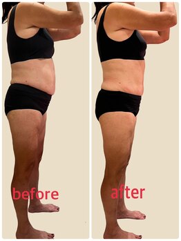 クリニカルエステ イーズ あべのキューズタウン店/【レモンボトルポッコリお腹解消