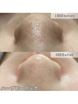 ネイルズビー 別邸(Nail's be)/ハーブピーリング