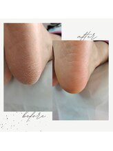 リゼラアンドコー 鹿沼店/角質ケア