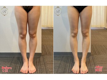 ルフレ(REFLET)/【事例11】Before/After痩身