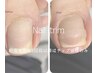【フットケア】韓国式巻き爪専用チップ「親指２枚」60分張替￥11,000