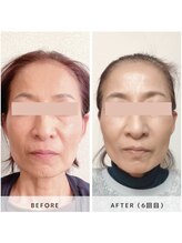 サロン レインボー(SALON RAINBOW)/小顔集中コース　Before/After