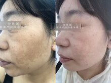 癒林(イーリン)/しみ改善