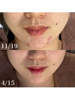 ホワイトアクア 天王寺本店(WHITE AQUA)/ハーブピーリング/大阪/天王寺