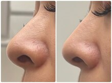 コニワ(528hz)/毛穴&フェイシャルBefore⇔After