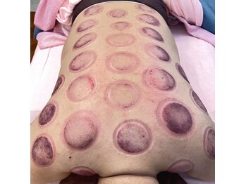 スイクウ ネオ(neo)/吸引式カッピングの跡