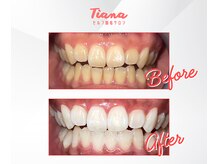 Before & After(セルフホワイトニング）