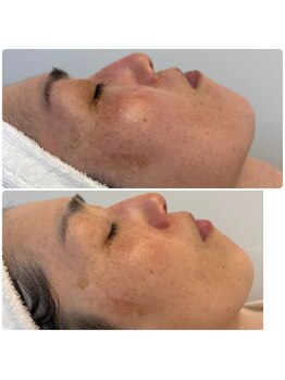 モンドレーヴ(mondereve)/お顔回りの毛全て取ります♪