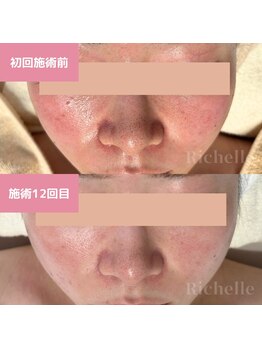 リシェル(Richelle)/ 【GREENPEELセンシダーム】