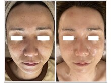 美しぐれ 溝の口/【8回】プラズマ/ピーリング/LDM