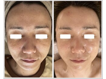 美しぐれ 溝の口/【8回】プラズマ/ピーリング/LDM