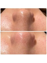 ポアレ(POARE)/毛穴変化(毛穴ハイドラ)