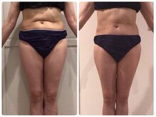 クランシュプール 恵比寿店/【ボディライン/引き締め】