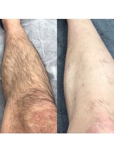 メンズサロンエヌエー(MEN'S SALON NA)/【足まるごと脱毛】剃毛なし写真