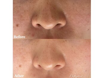 ベルアイラッシュ(Belleyelash)/【フェイシャルワックス】