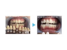 ミスターアンドミス脱毛専門店 難波店(Mr.&Ms.脱毛専門店)/セルフホワイトニング